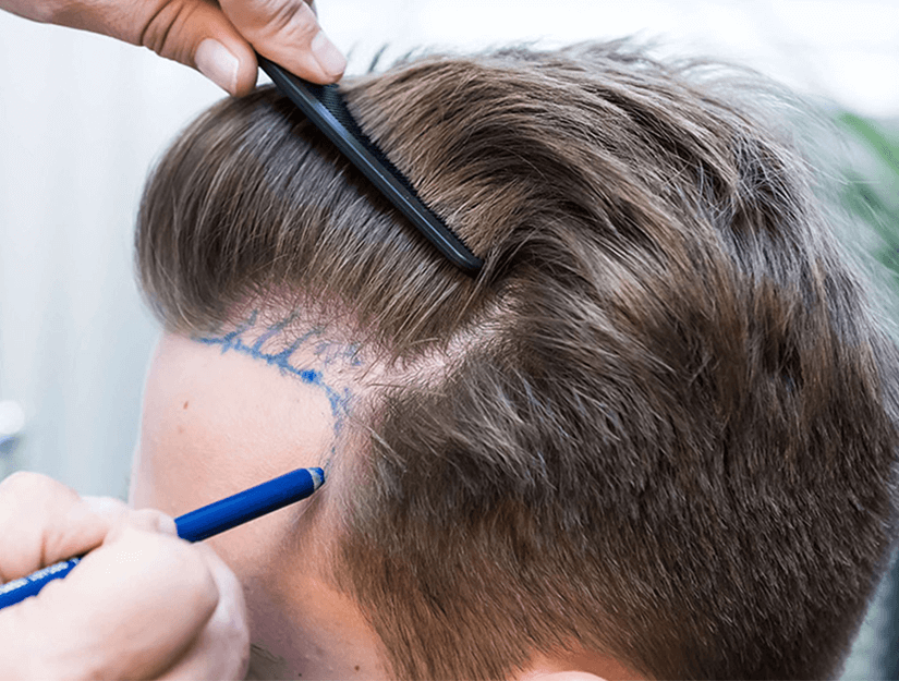 How to do hair transplantation?